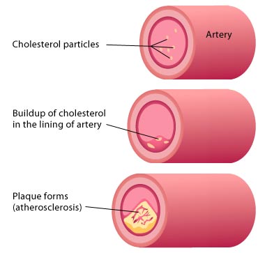 Good articles to help you lower your cholesterol 